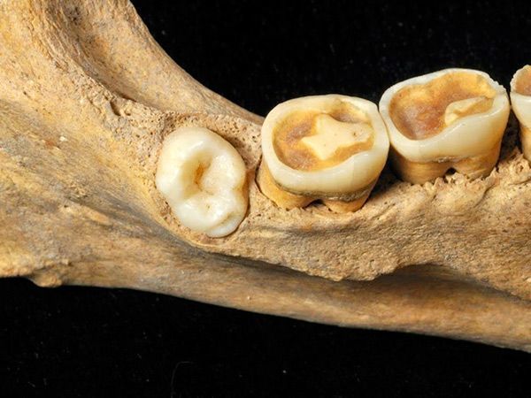 Identifican por primera vez a un homínido de Atapuerca con un molar extra