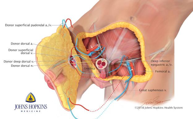 Primer trasplante de pene y escroto del mundo