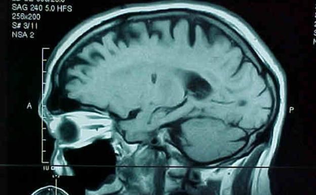 La terapia CART acaba con el cáncer cerebral