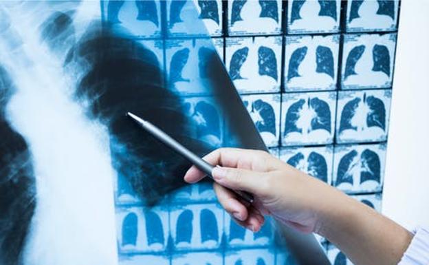 Rayos X e inteligencia artificial para evitar falsos negativos