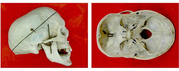 Estudian los efectos de la fusión prematura de las suturas en los vasos sanguíneos del cráneo