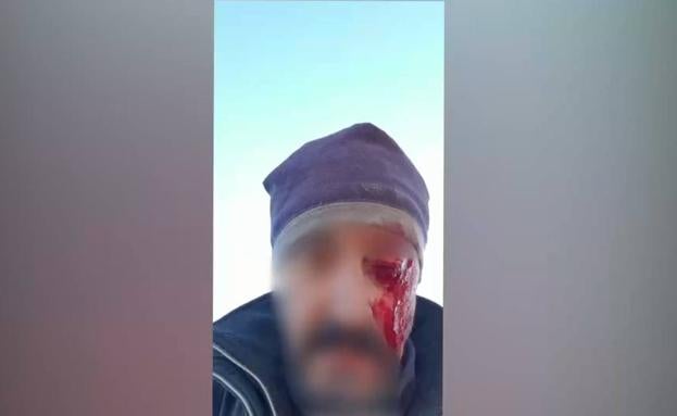 Pierde un ojo tras ser agredido por dos hombres cazando ilegalmente