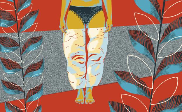 Esa grasa que se acumula en las piernas no es obesidad, es lipedema