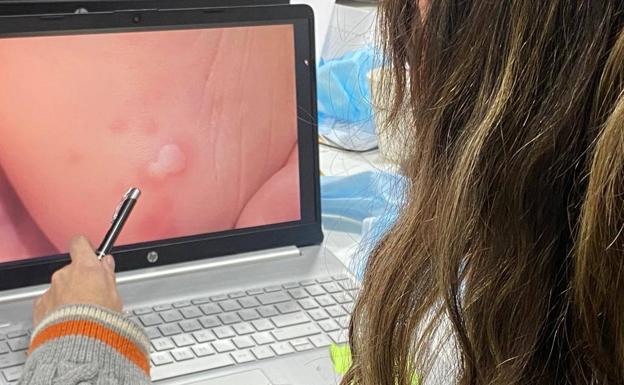 Un software para mejorar el diagnóstico en Dermatología en Burgos